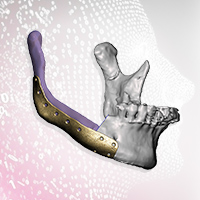 3D Implant